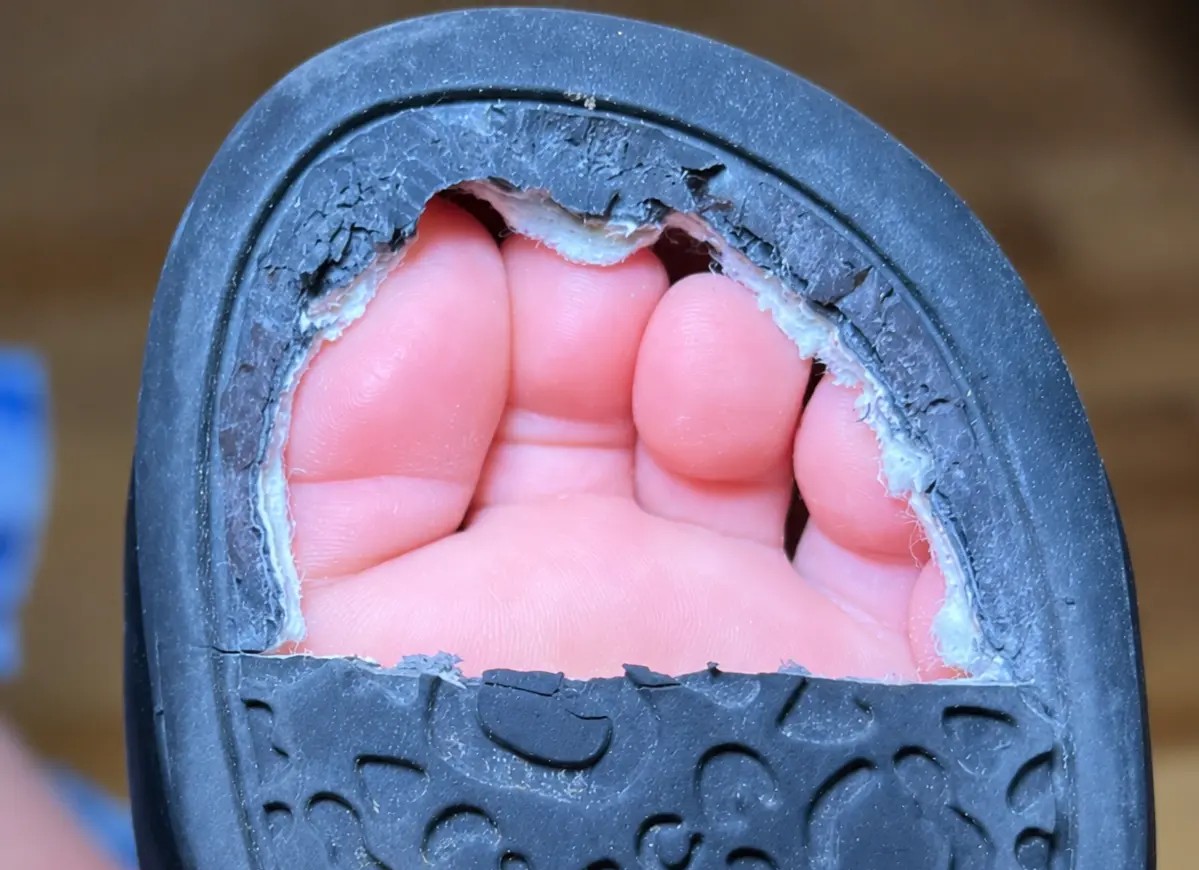 Avant : les orteils comprimés dans une chaussure classique
